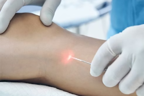 Endovenous Laser Ablation