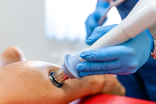 Endovenous Radio Frequency Ablation